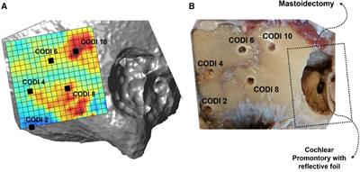 Evaluating temporal bone column density for optimized bone conduction implant placement